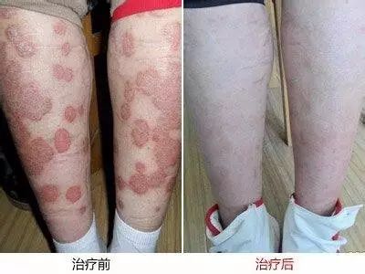 牛皮癣治疗九大准则